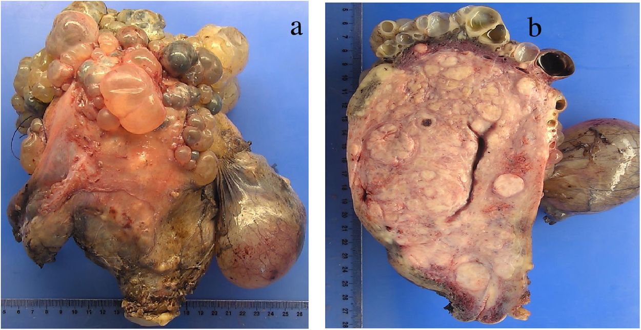 30-facts-about-florid-cystic-endosalpingiosis-of-the-uterus