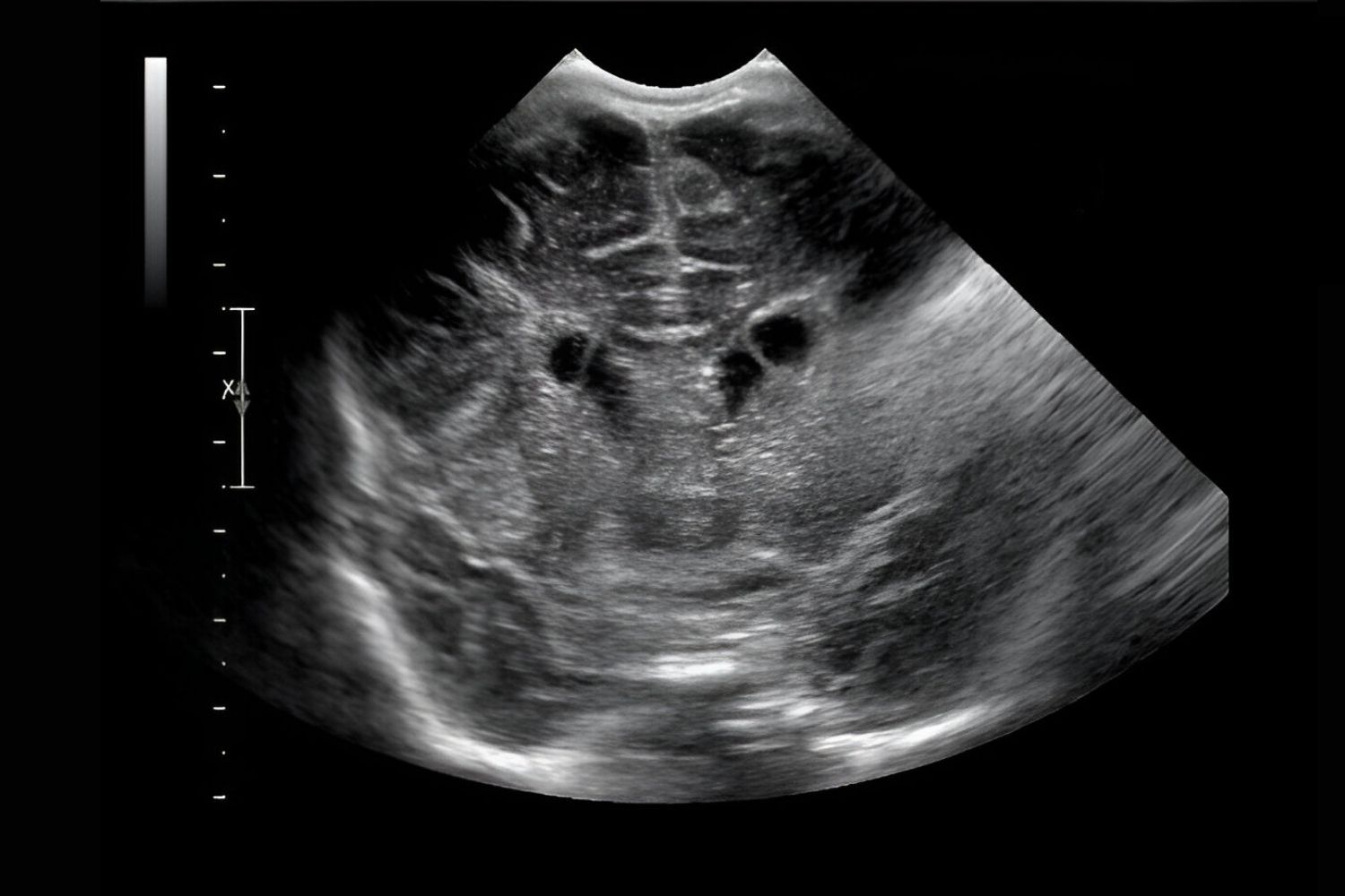 30-facts-about-frontal-horn-cyst