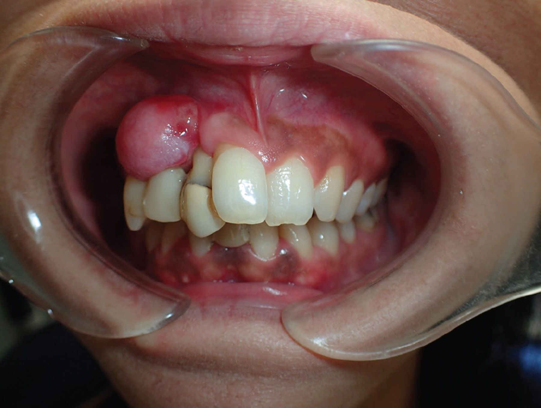 30-facts-about-gingival-fibrosis