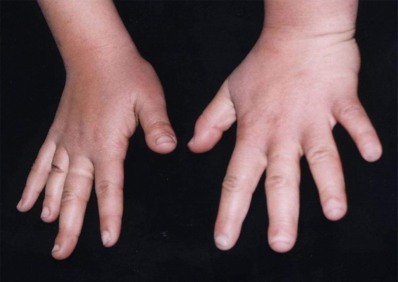 30-facts-about-growth-deficiency-brachydactyly-unusual-facies