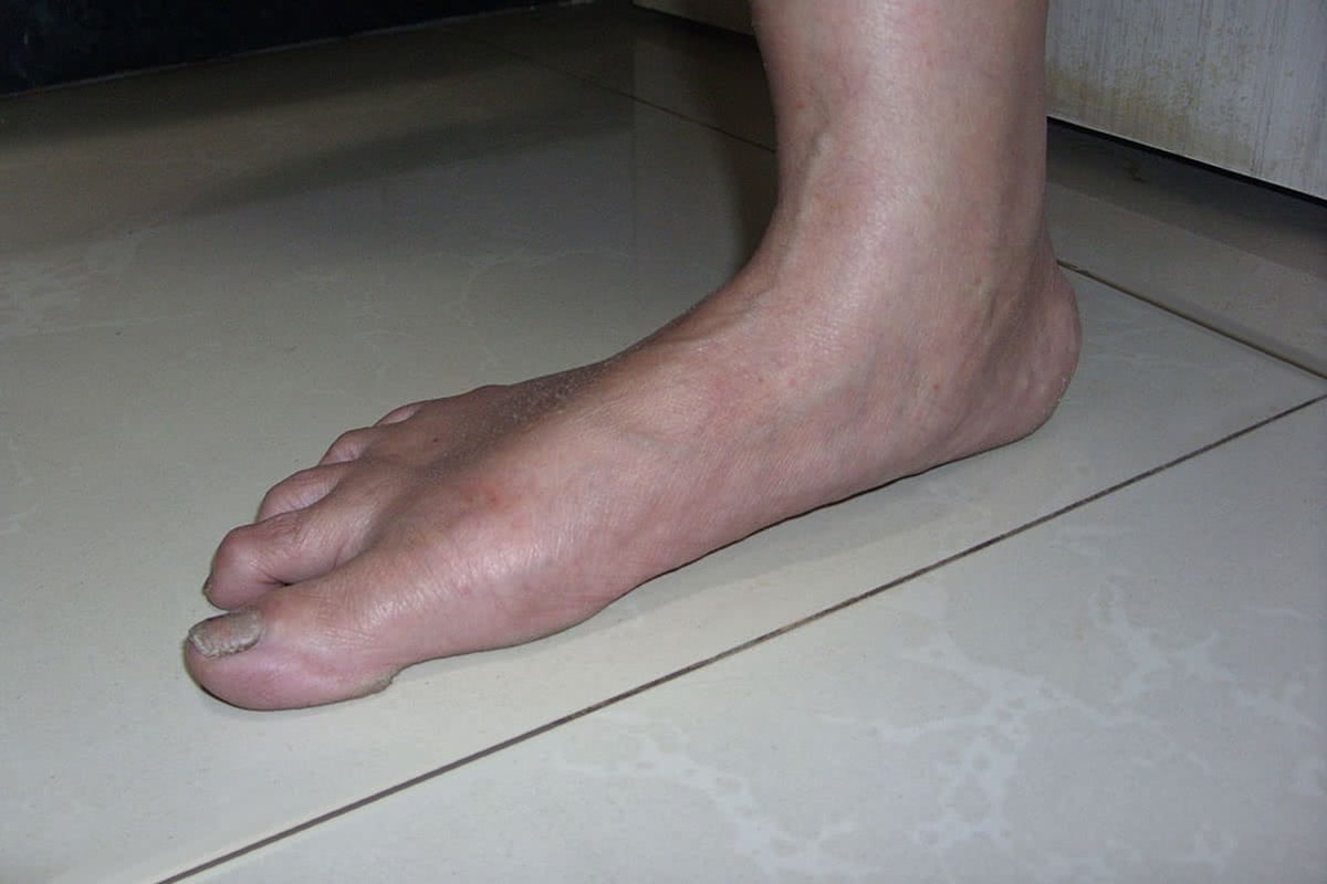 30-facts-about-hand-and-foot-deformity-flat-facies