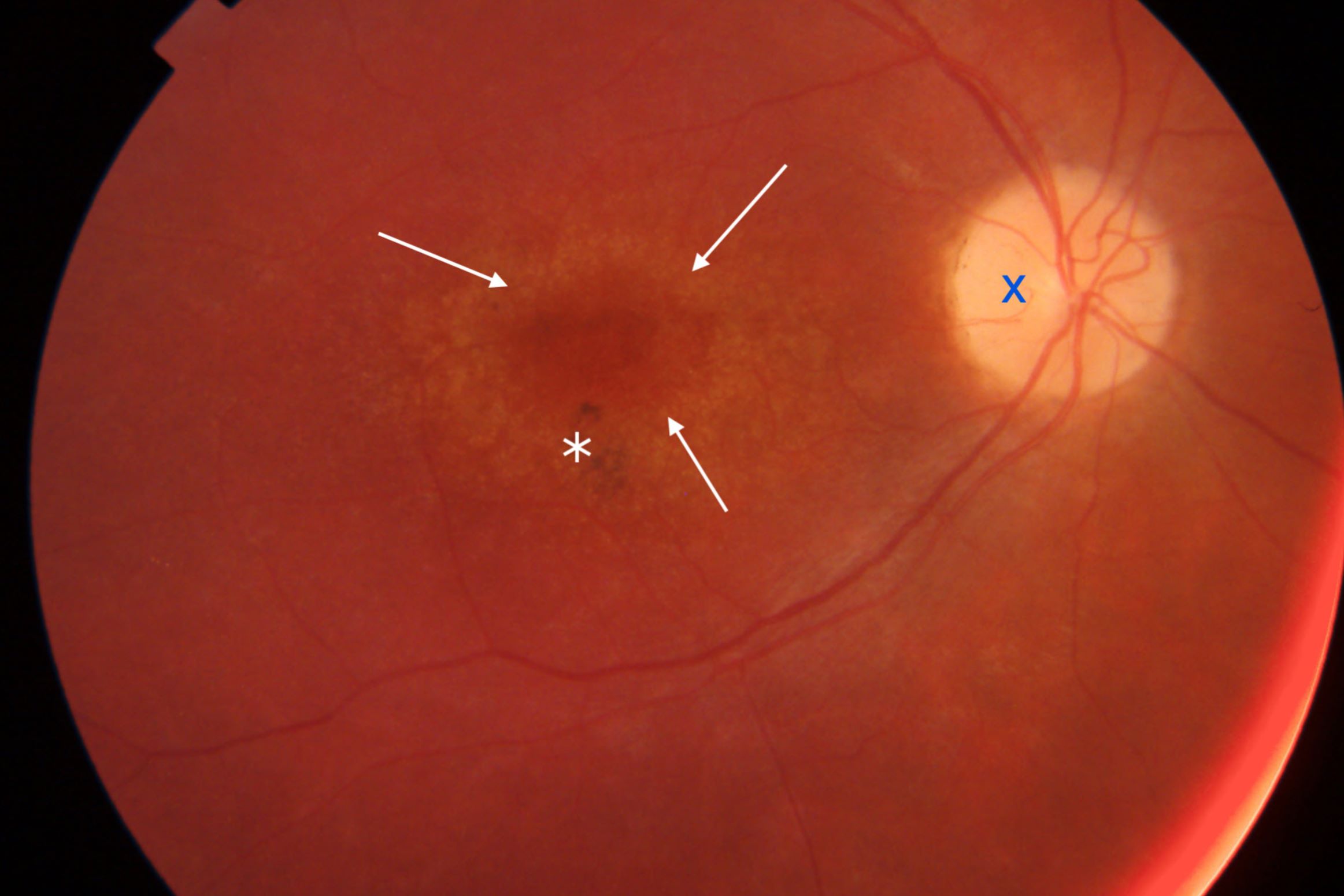 30-facts-about-late-onset-dominant-cone-dystrophy