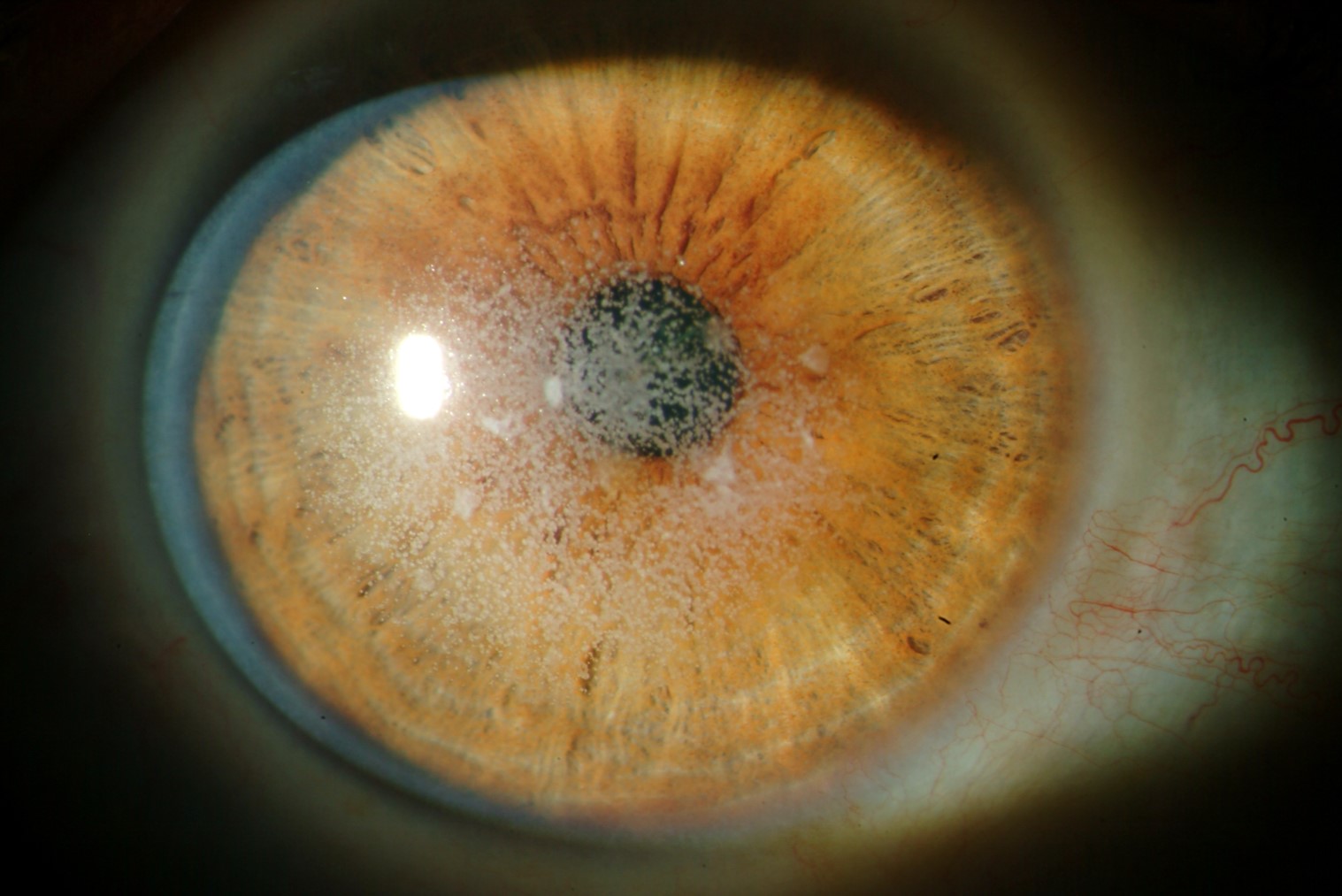 30-facts-about-lattice-corneal-dystrophy-type-2