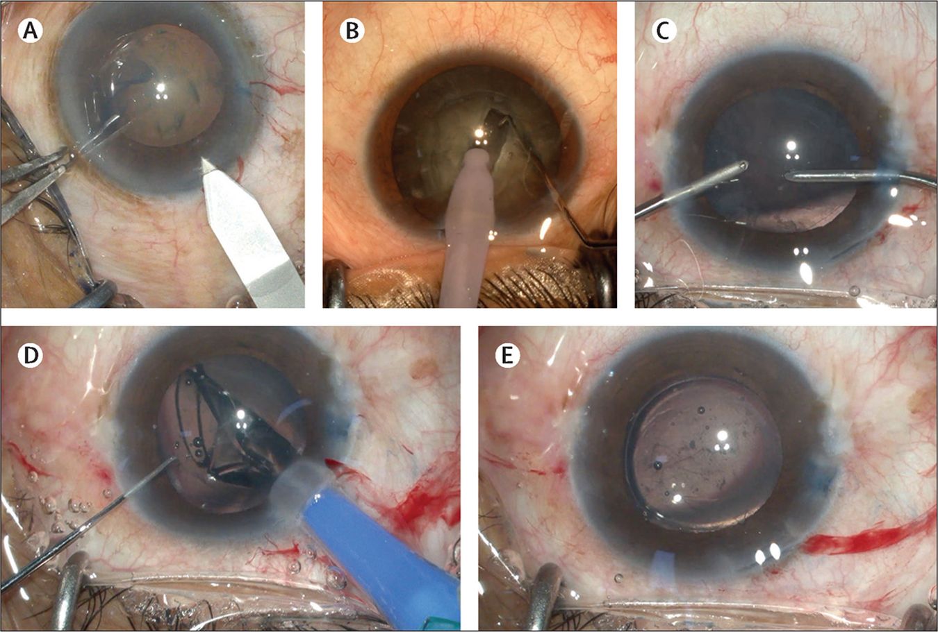 30-facts-about-leg-absence-deformity-cataract