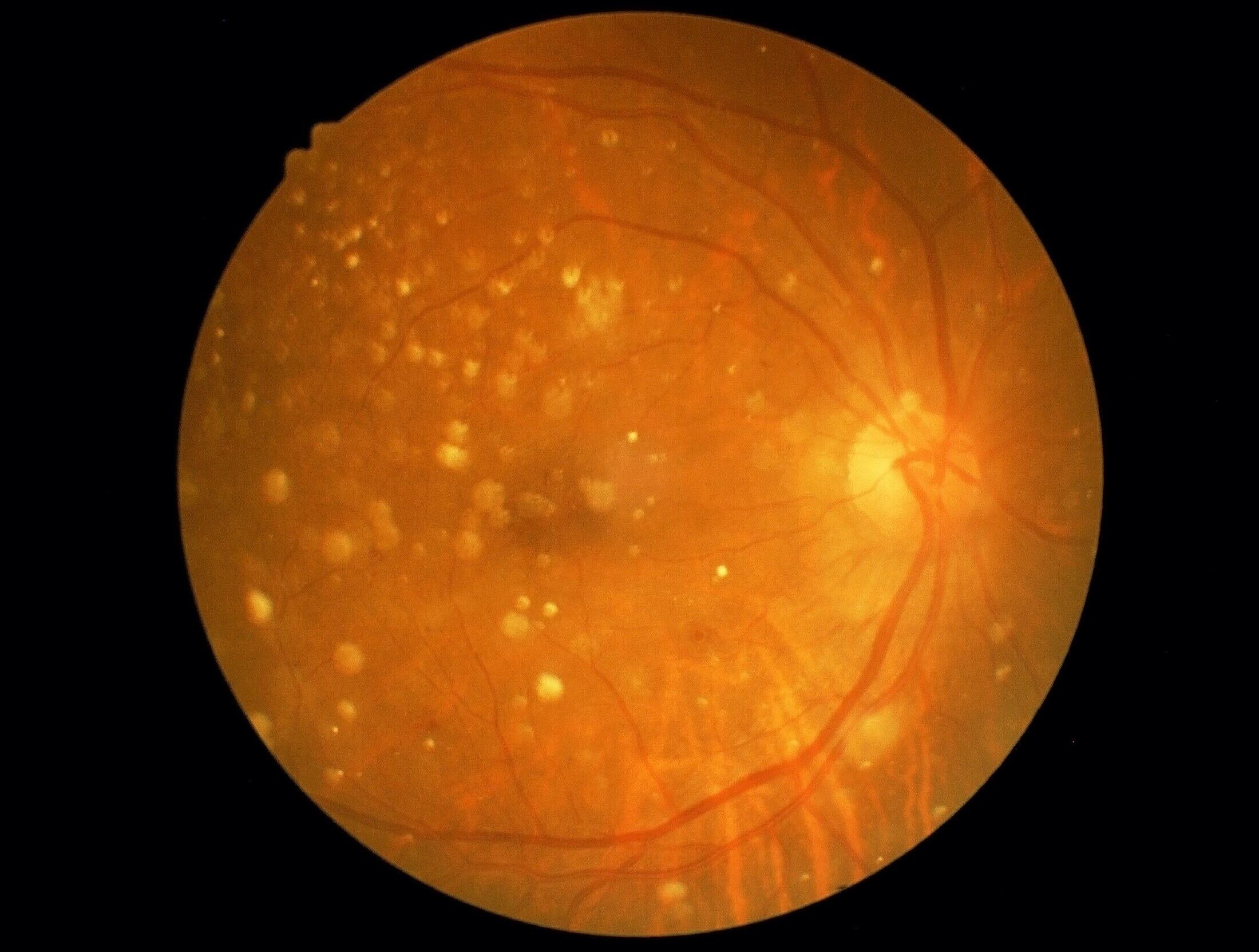 30-facts-about-macular-degeneration