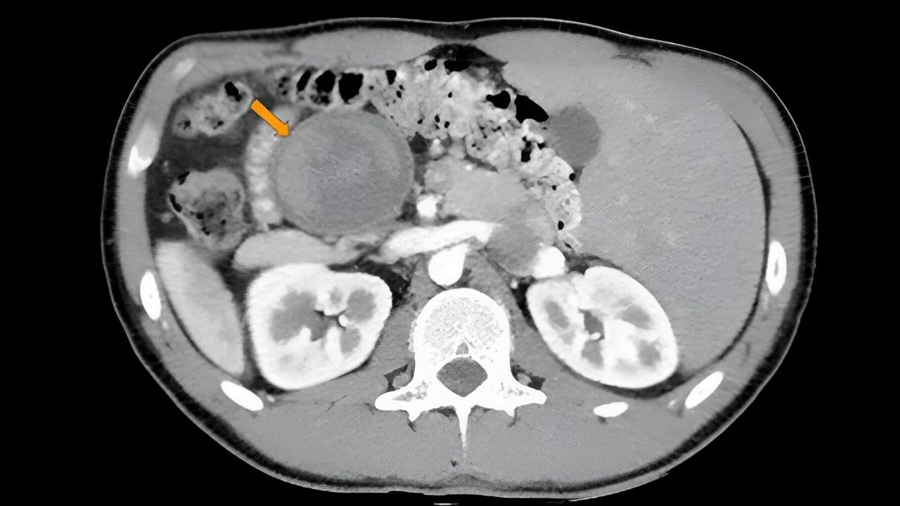 30-facts-about-mesenteric-pseudocyst