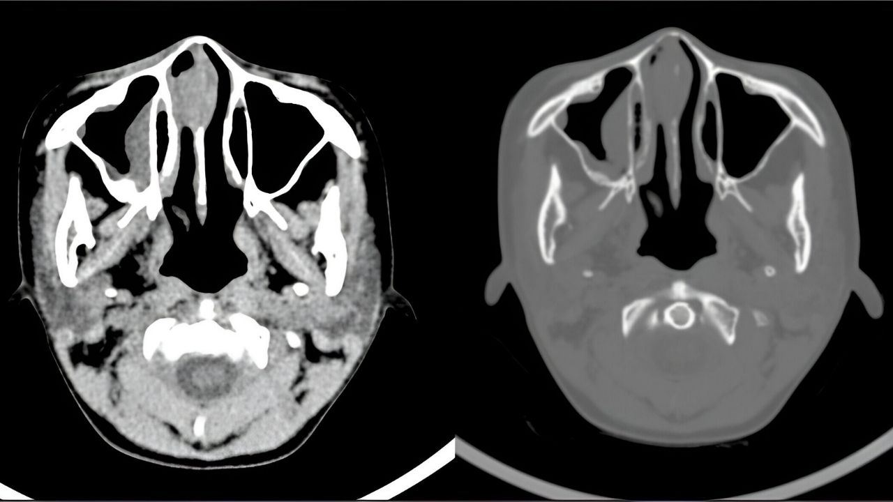 30-facts-about-midline-lethal-granuloma