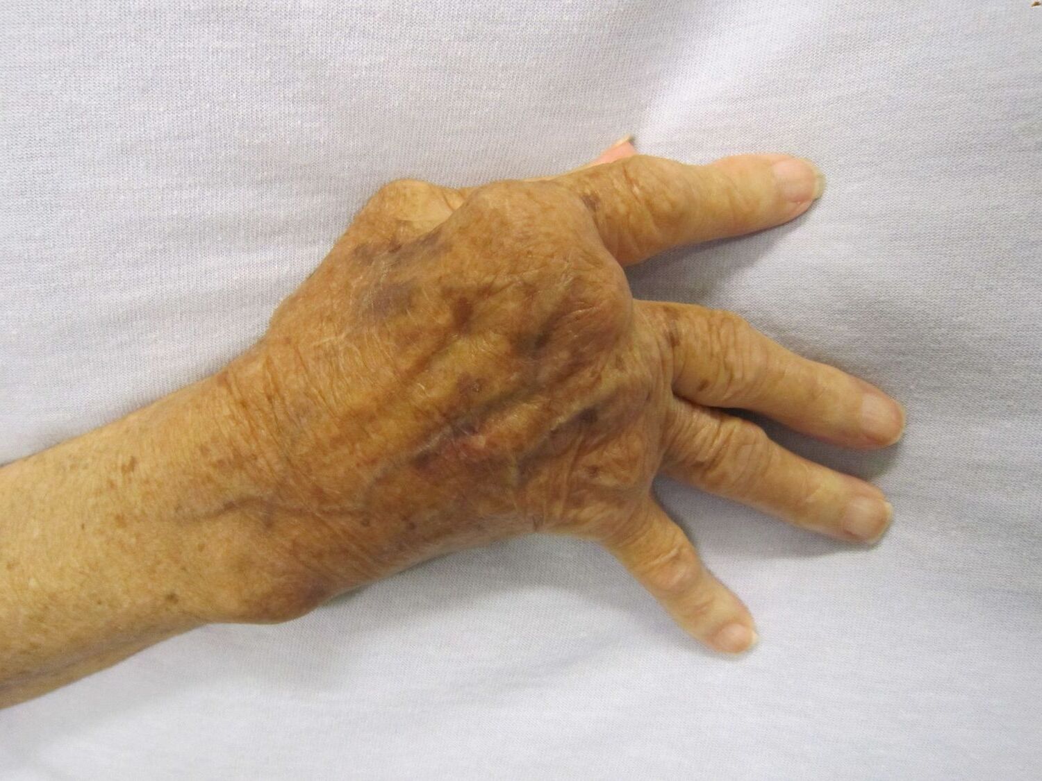 30-facts-about-negative-rheumatoid-factor-polyarthritis