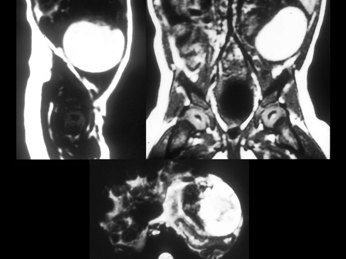 30-facts-about-neonatal-ovarian-cyst