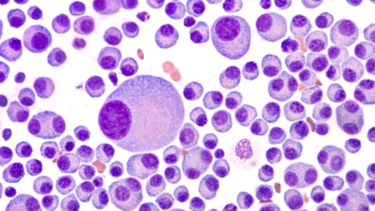 30-facts-about-plasma-cell-neoplasm-multiple-myeloma