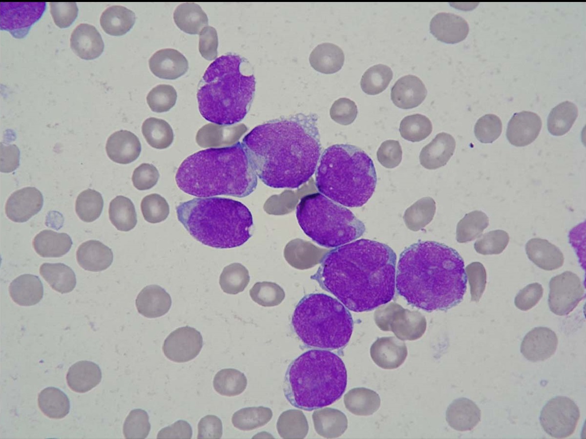 30-facts-about-precursor-b-lymphoblastic-leukemia