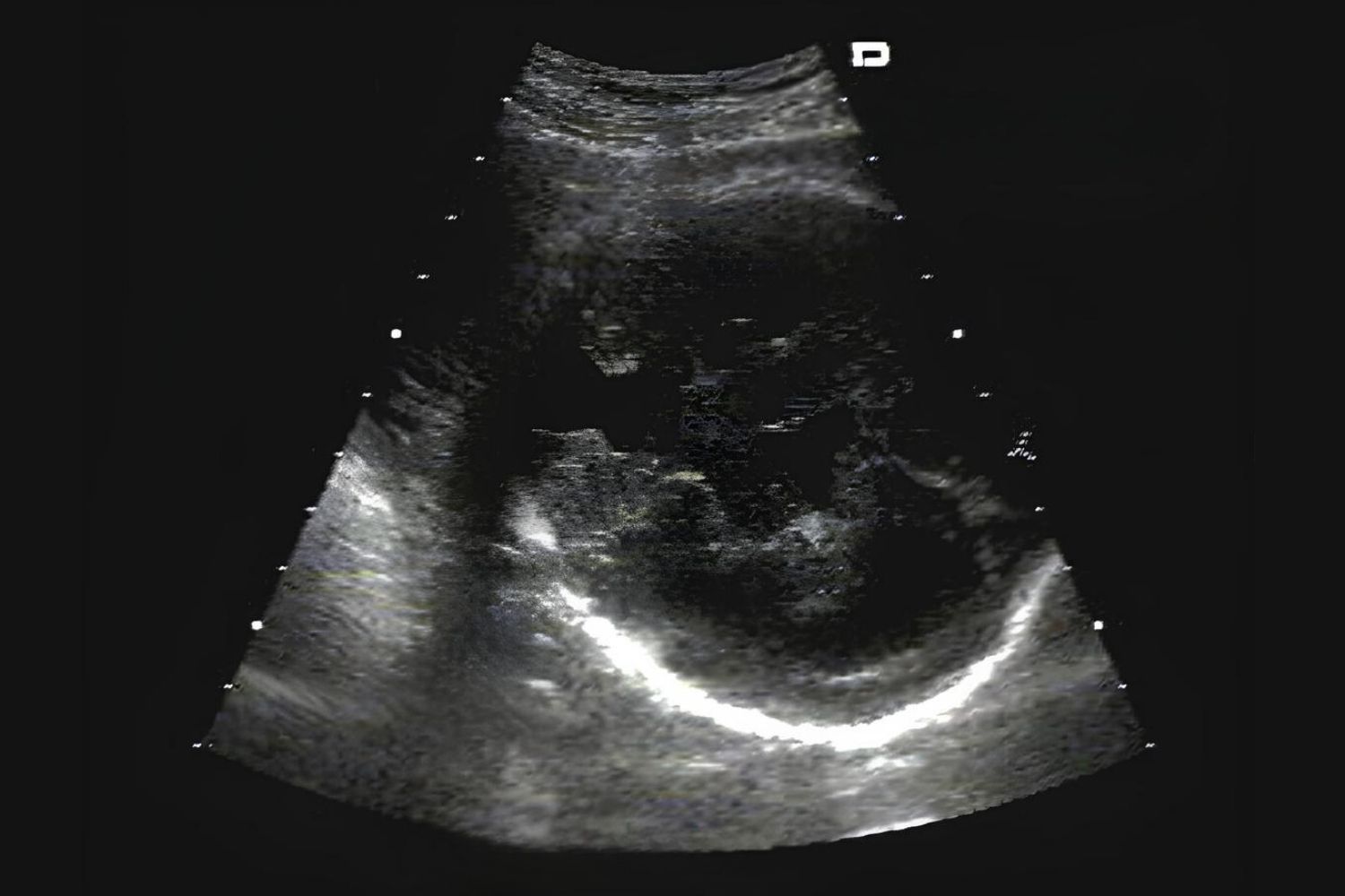 30-facts-about-renal-hepatic-pancreatic-dysplasia-dandy-walker-cyst