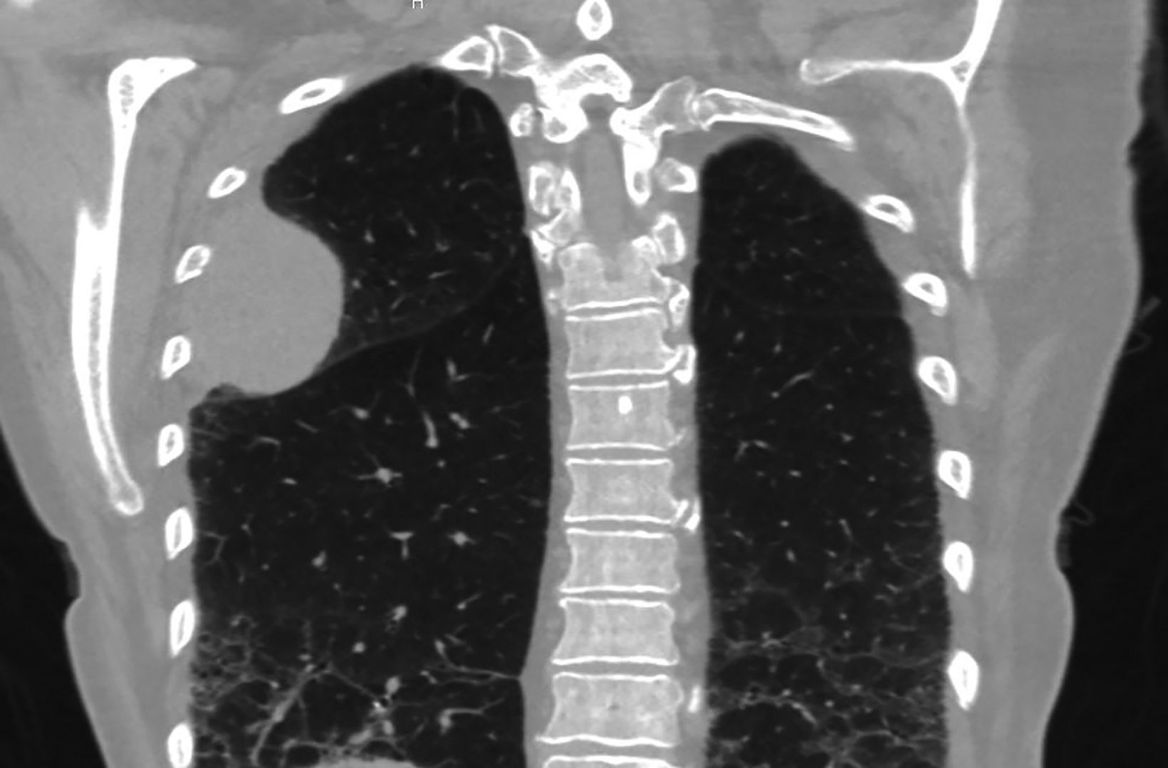 30-facts-about-sarcomatoid-carcinoma-of-the-lung