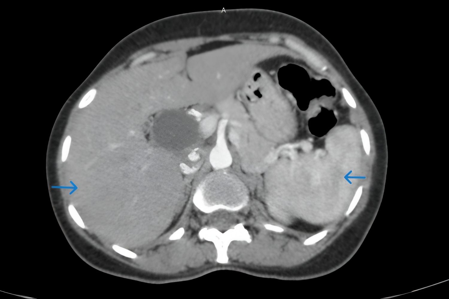 30 Facts About Situs Inversus Totalis With Cystic Dysplasia Of Kidneys ...