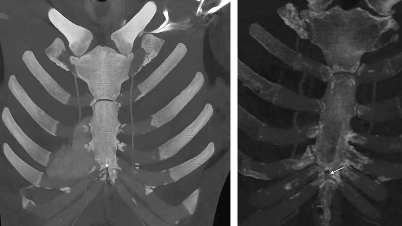 30-facts-about-sternal-cyst-vascular-anomalies