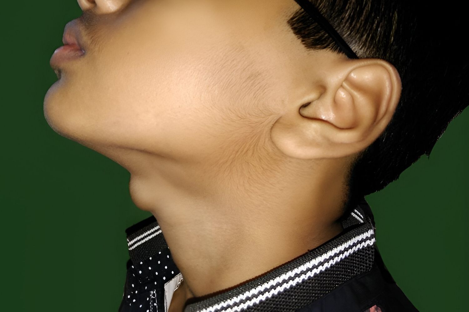 30-facts-about-thyroglossal-tract-cyst