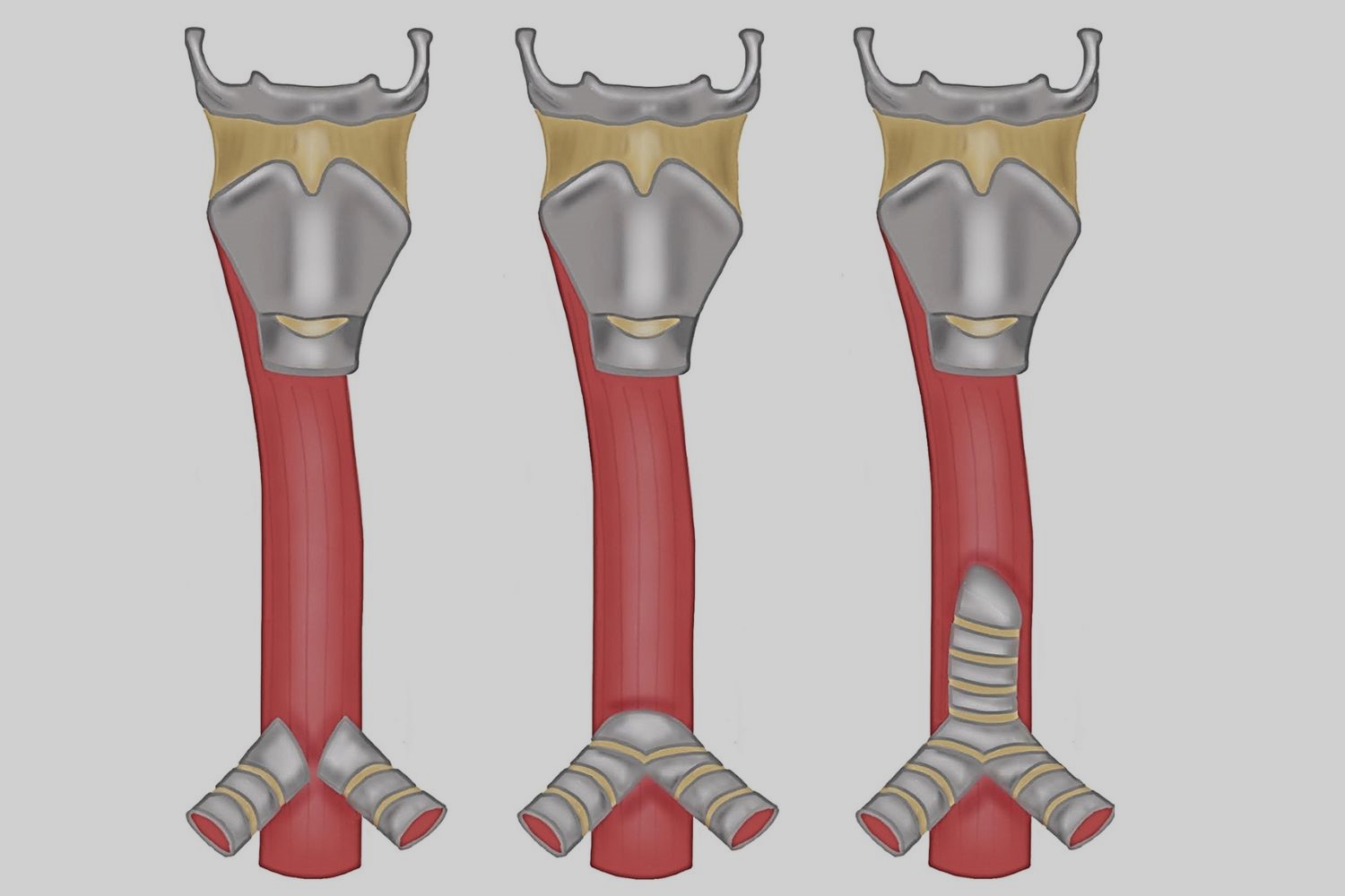 30-facts-about-tracheal-agenesis