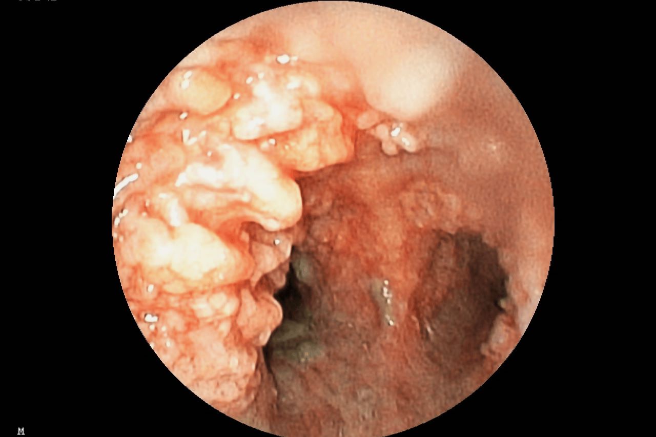 30-facts-about-tracheobronchopathia-osteoplastica