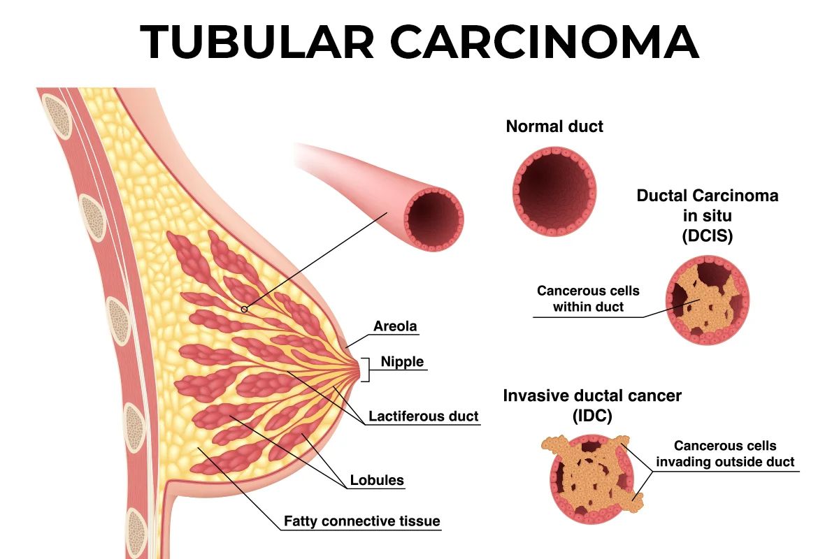 30-facts-about-tubular-carcinoma