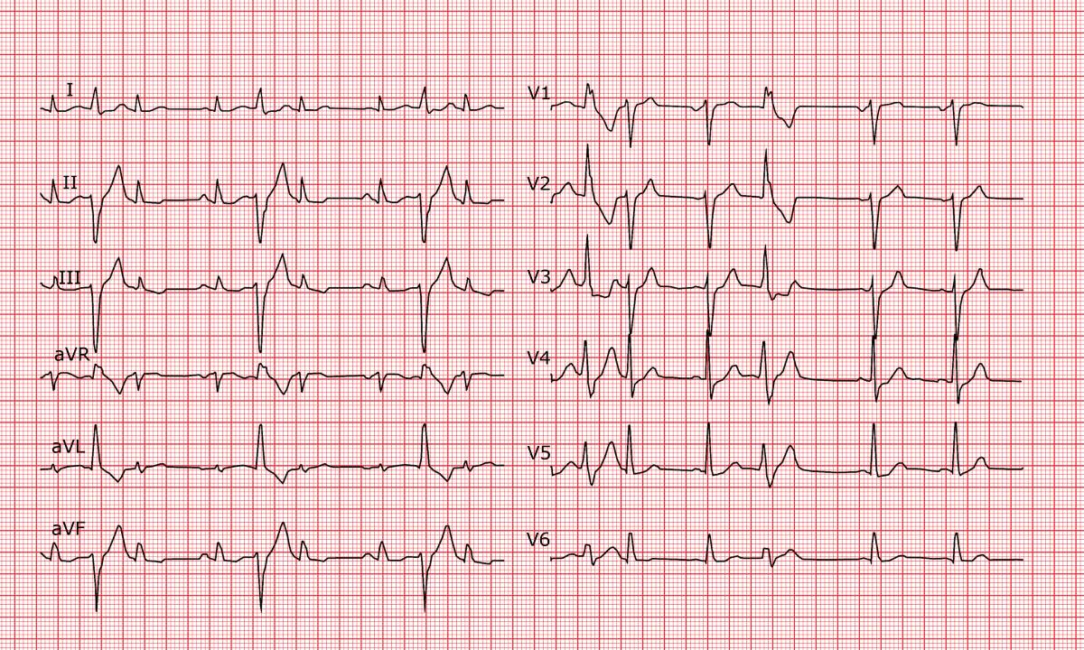 30-facts-about-ventricular-extrasystoles