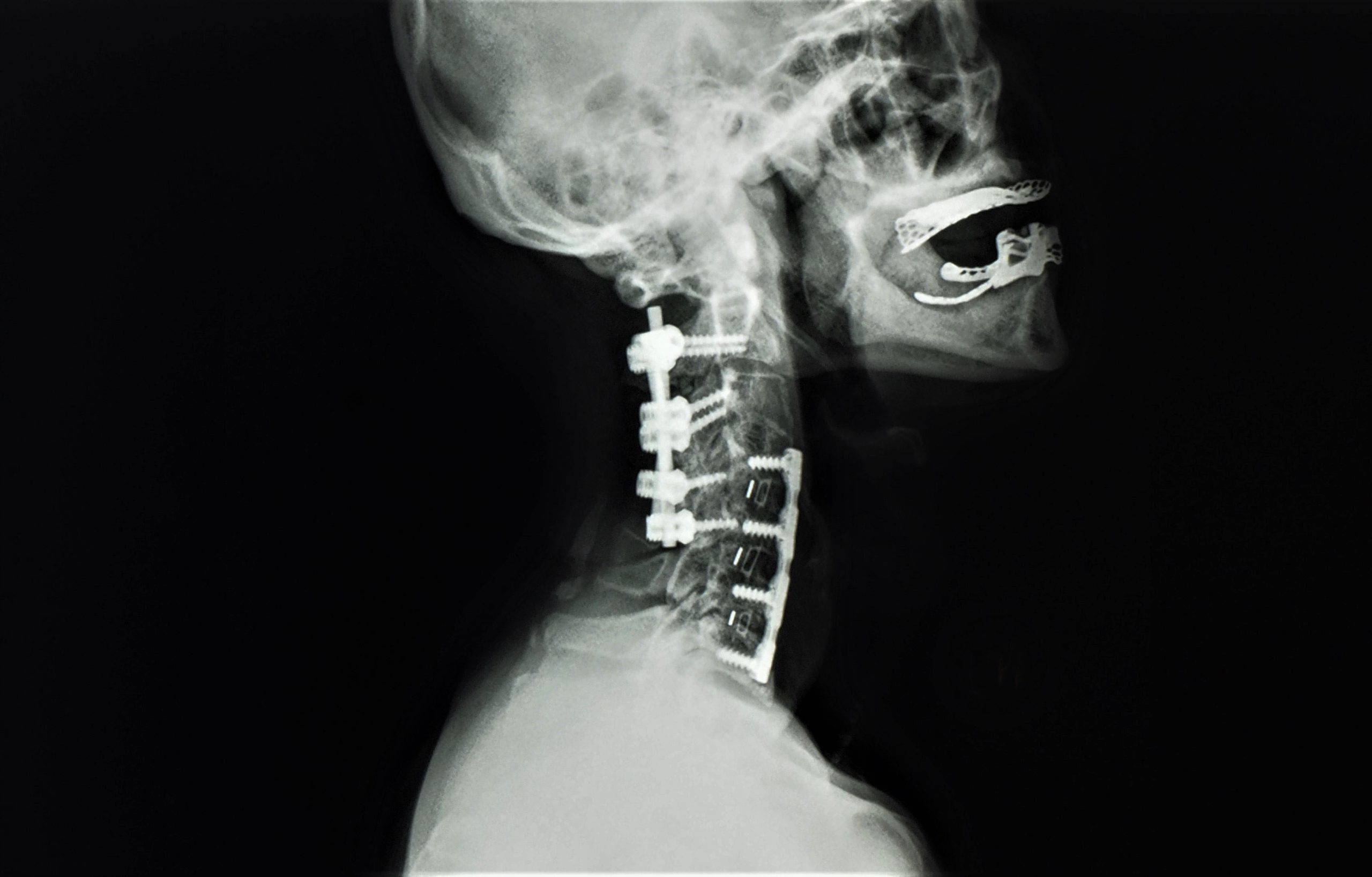 32-facts-about-cervical-vertebral-fusion