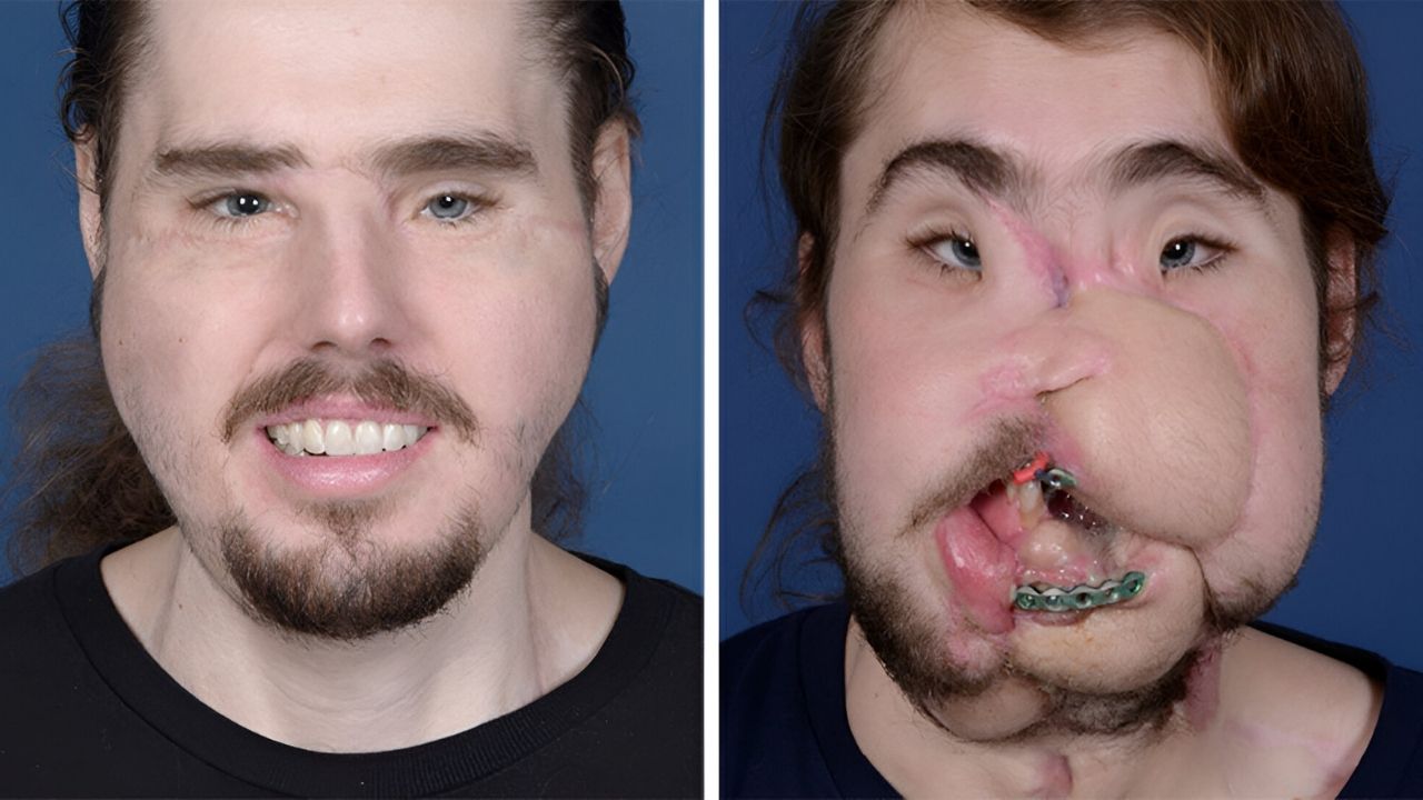 35-facts-about-cameron-underwood-face-transplant