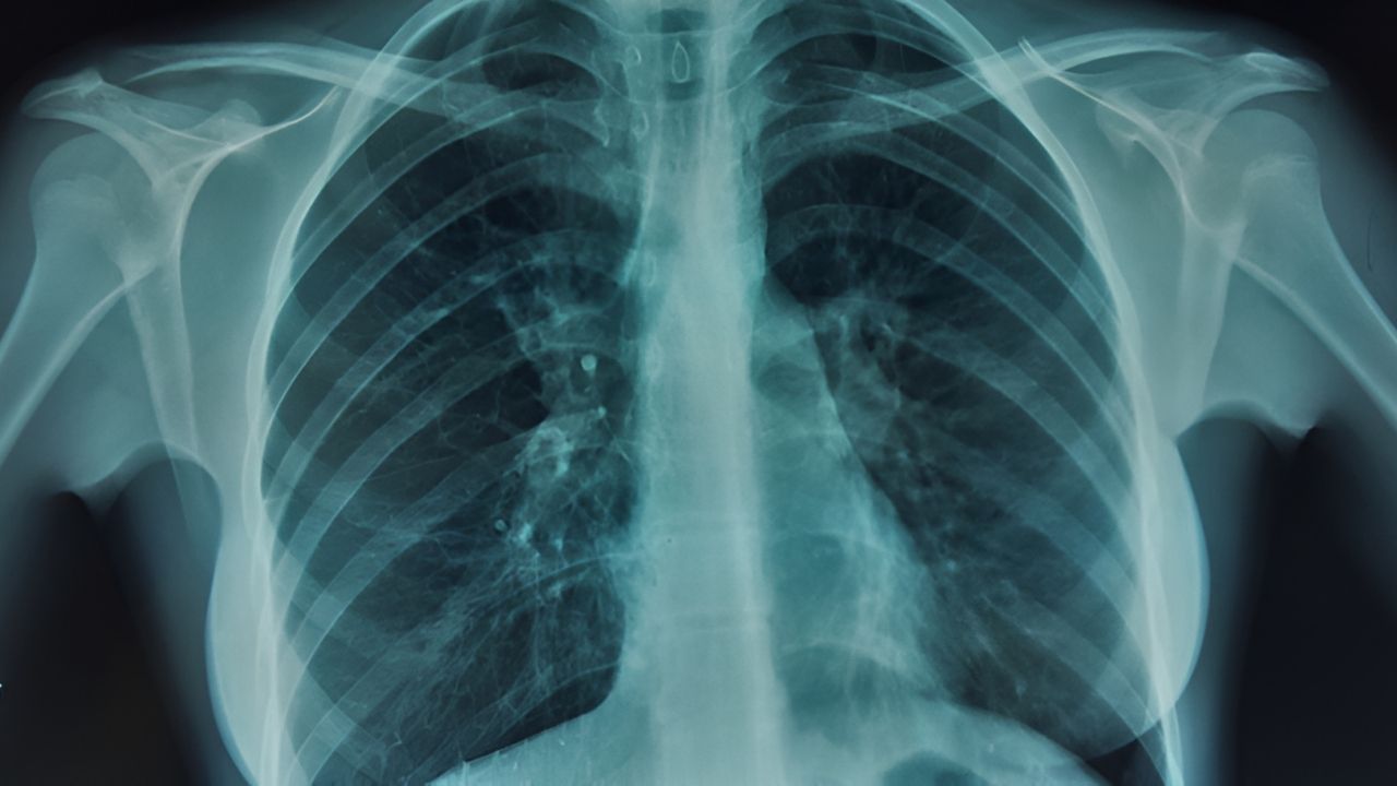 35-facts-about-dextrocardia-bronchiectasis-sinusitis