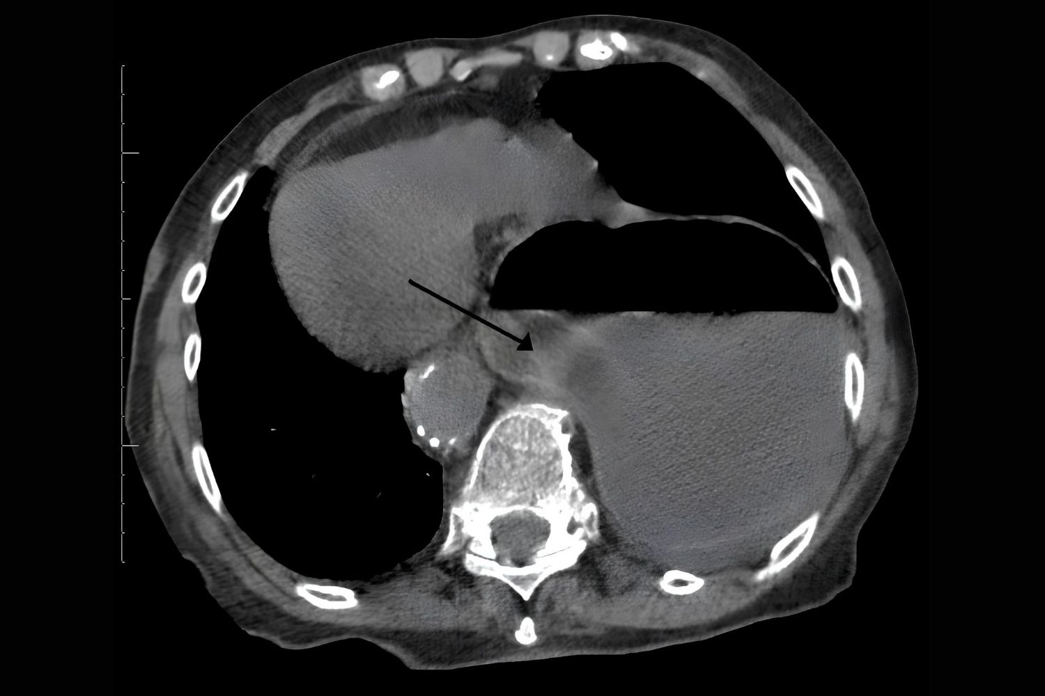 35-facts-about-diaphragmatic-defect-limb-deficiency-skull-defect