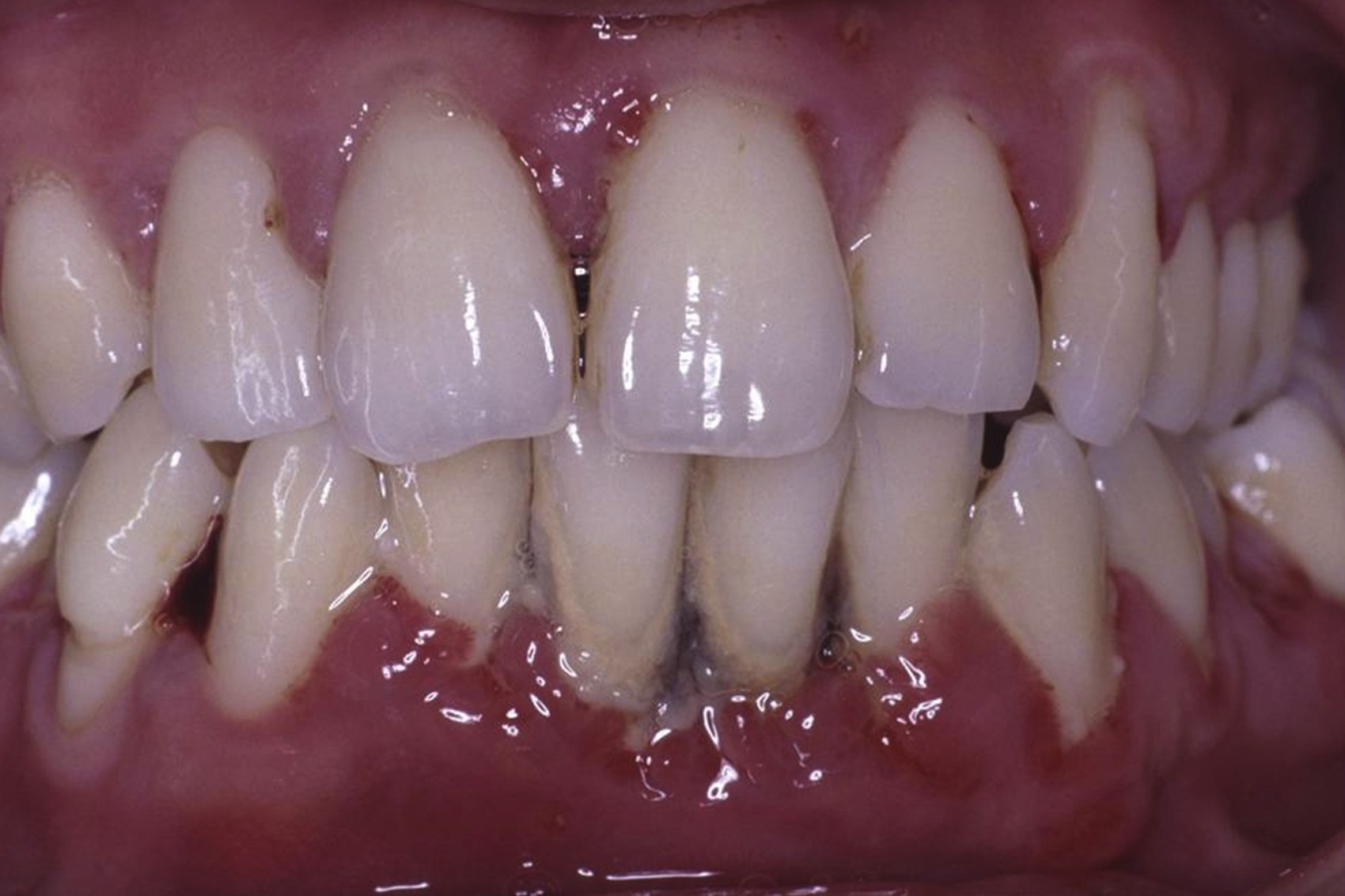 35-facts-about-gingival-hirsutism