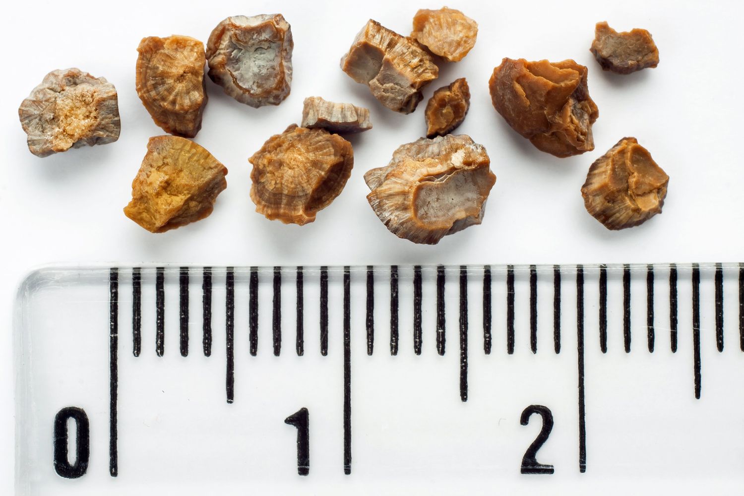 35-facts-about-kidney-stones