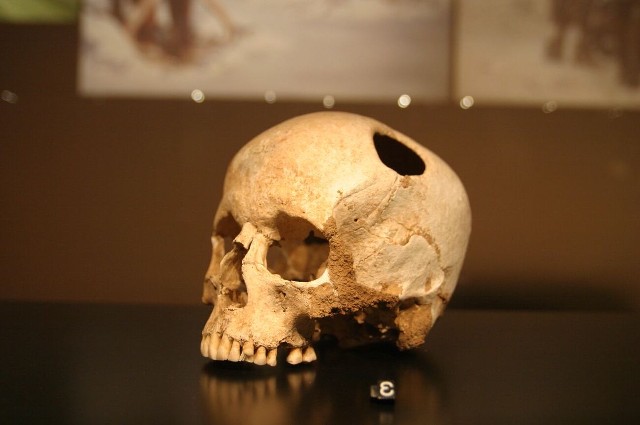 35-facts-about-neolithic-ear-surgery