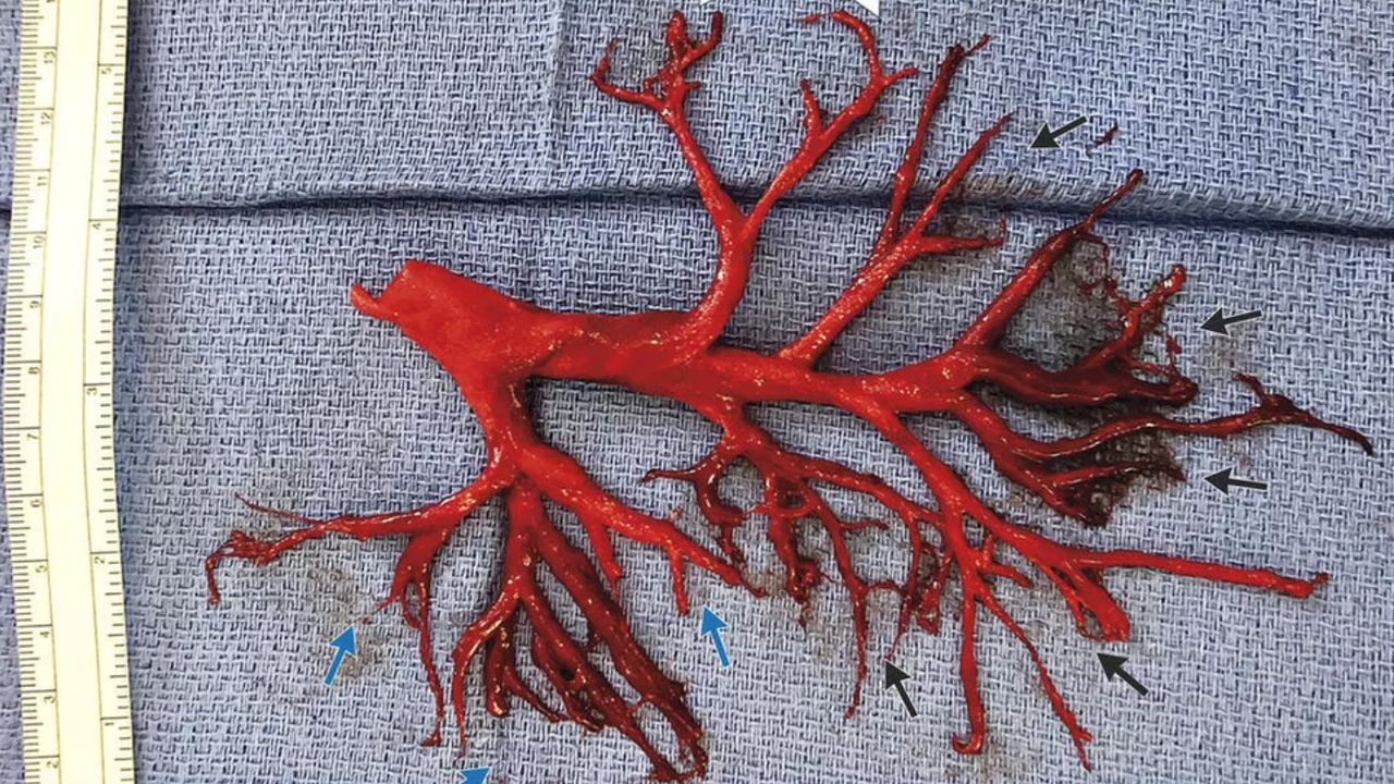 37-facts-about-bronchial-tree-blood-clot