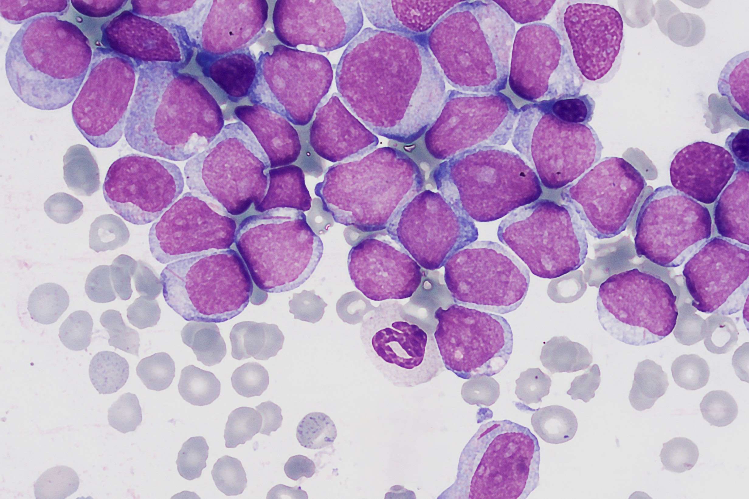 40-facts-about-acute-biphenotypic-leukemia