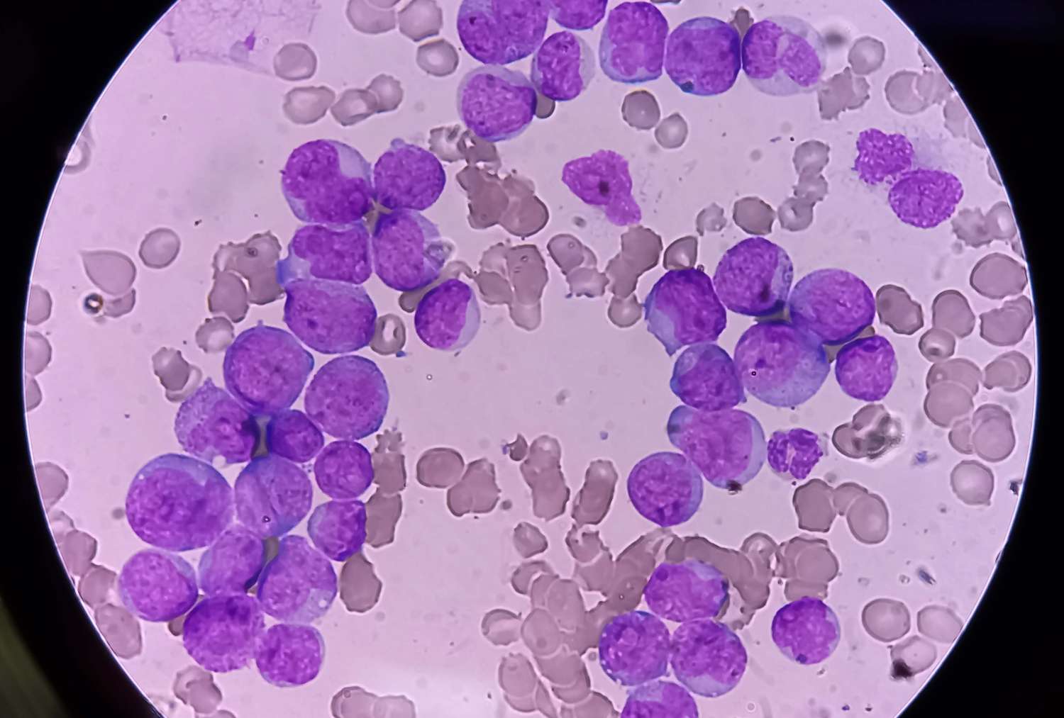 40-facts-about-acute-myeloid-leukemia-aml