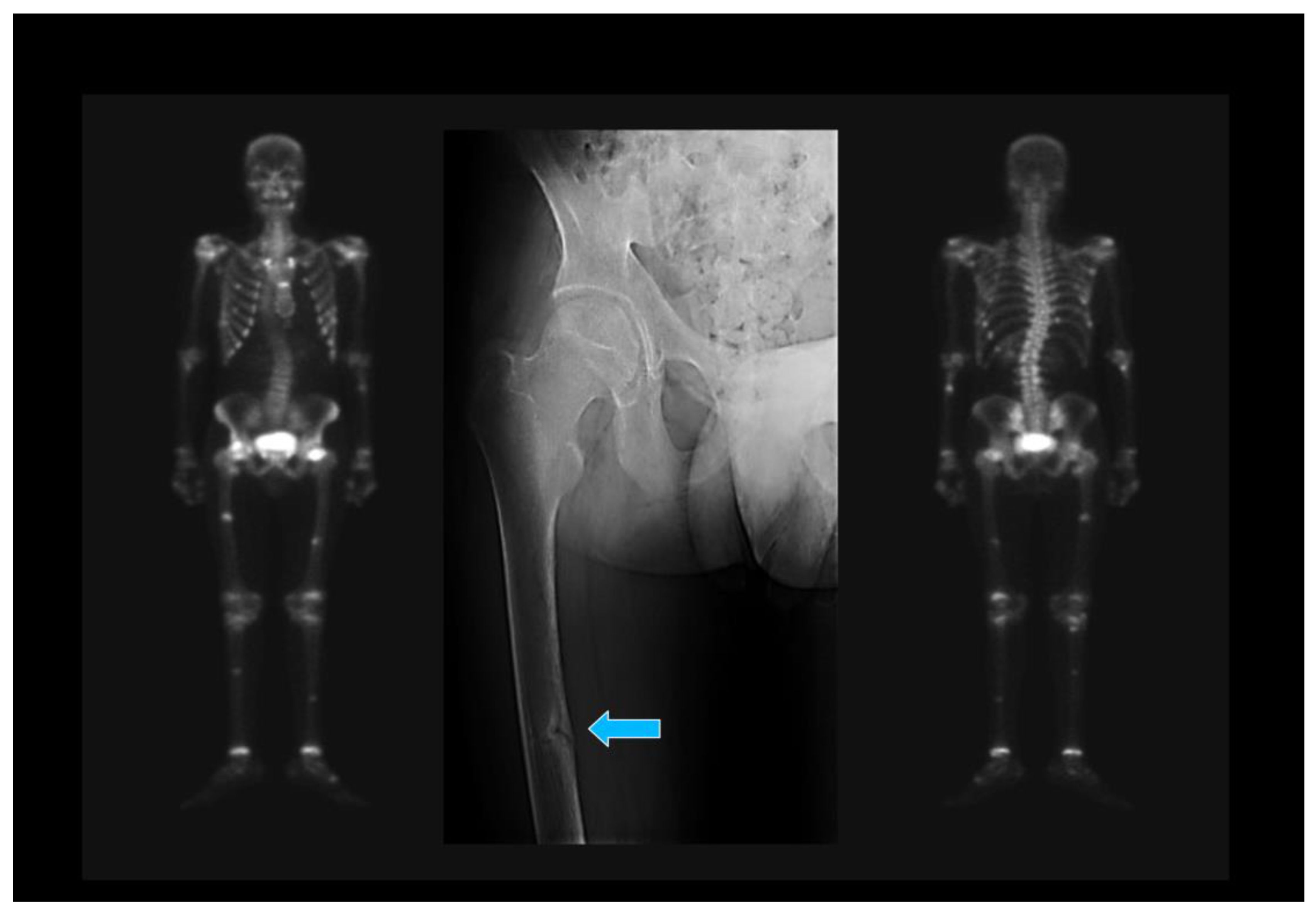 40-facts-about-axial-osteomalacia