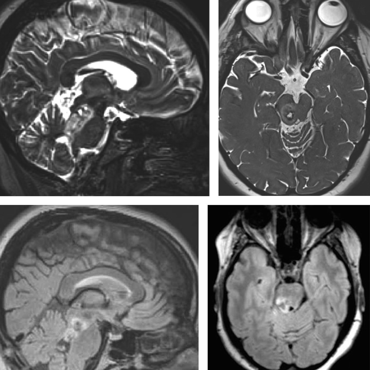 40-facts-about-brainstem-glioma