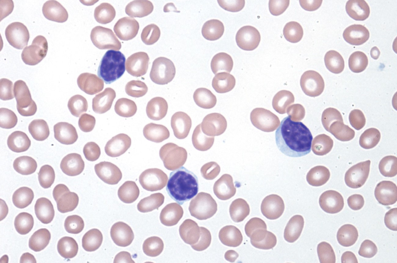 40-facts-about-chronic-lymphocytic-leukemia-cll