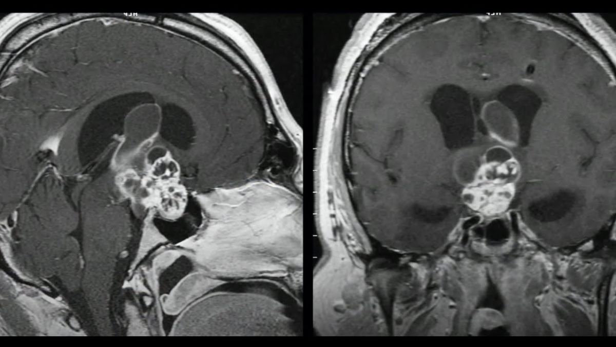 40-facts-about-craniopharyngioma