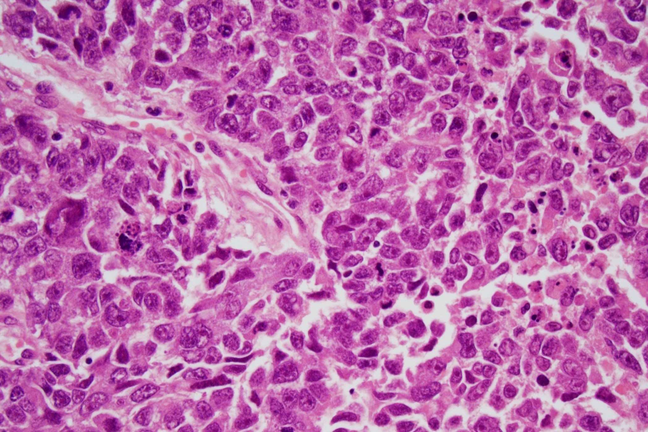 40-facts-about-embryonal-carcinoma