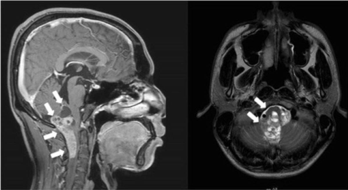 40-facts-about-ependymoma