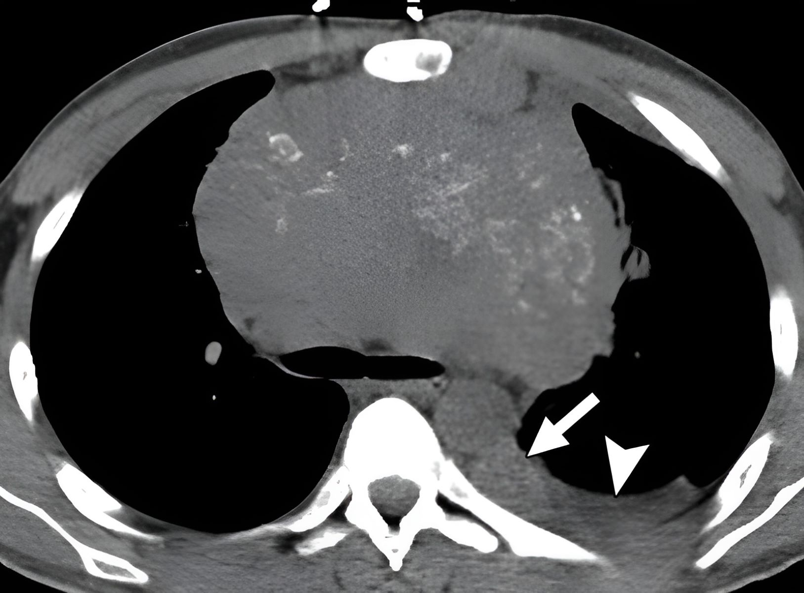 40-facts-about-extragonadal-germ-cell-tumor