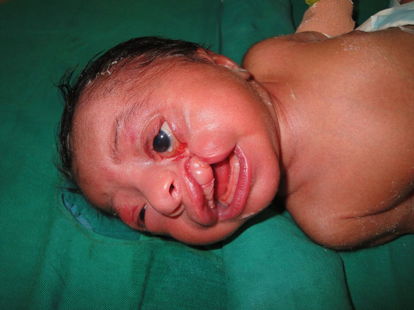 40-facts-about-facial-cleft