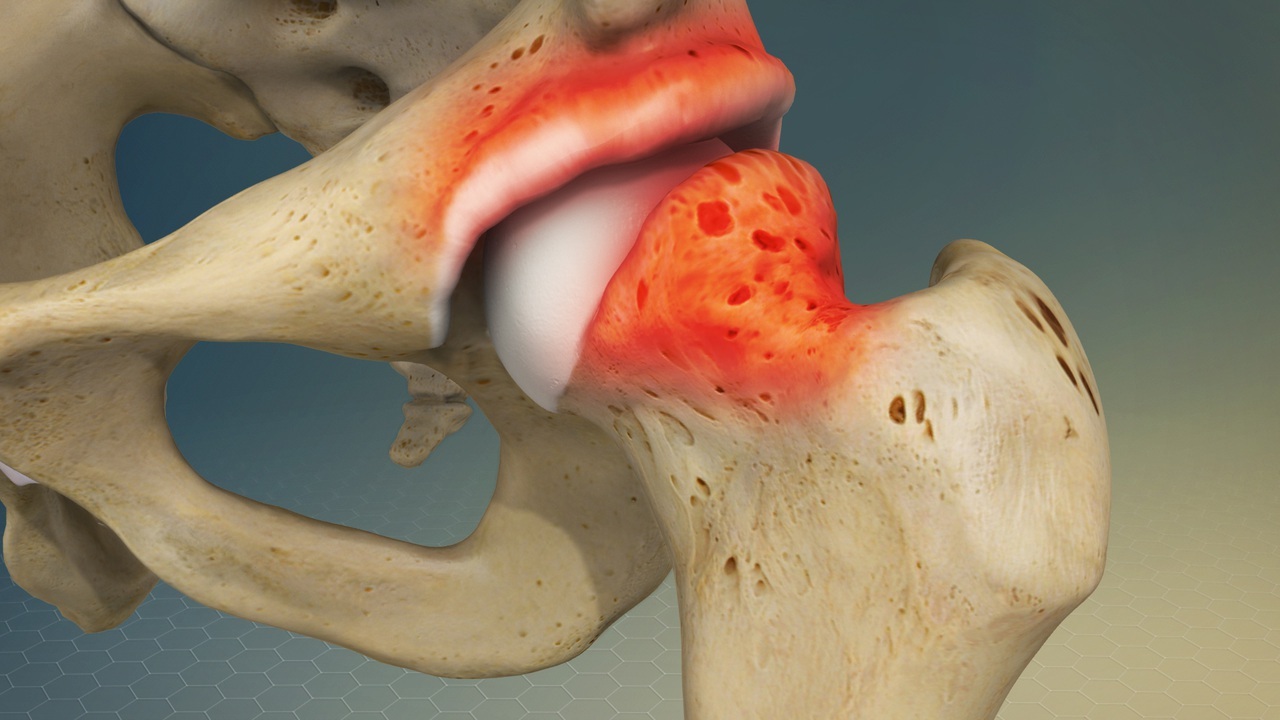 40-facts-about-femoroacetabular-impingement