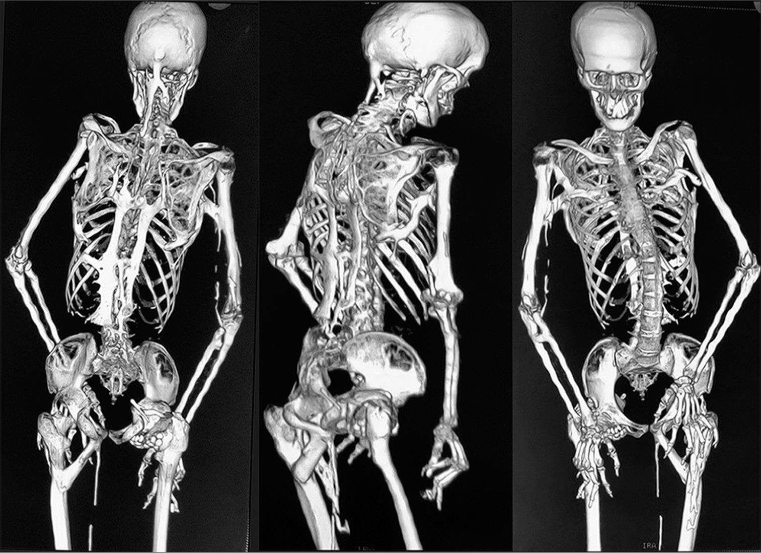 40-facts-about-fibrodysplasia-ossificans-progressiva