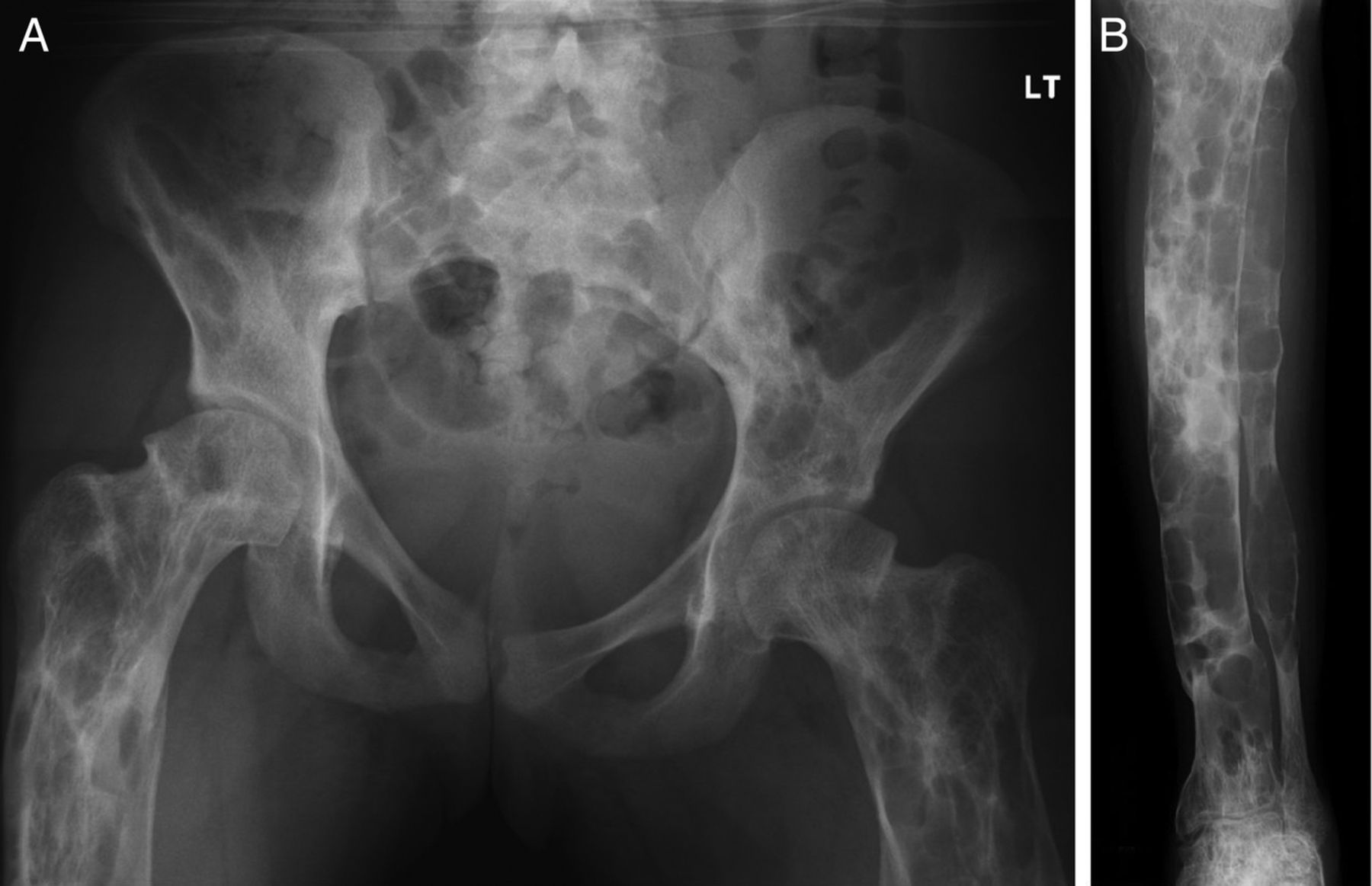 40 Facts About Fibrous Dysplasia Of Bone - Facts.net