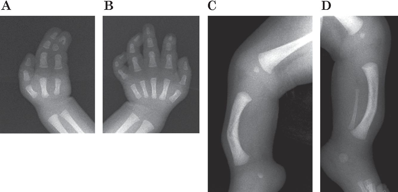 40-facts-about-fibular-aplasia-ectrodactyly