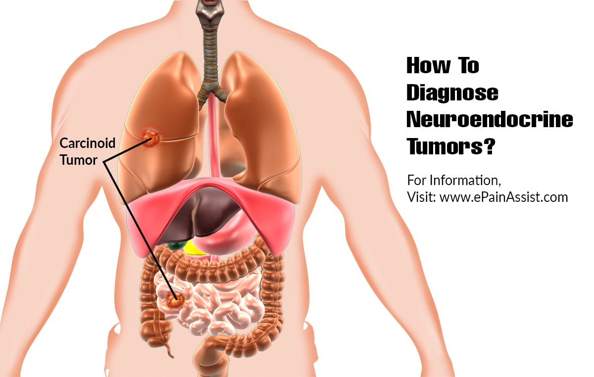 40-facts-about-gastrointestinal-neuroendocrine-tumors