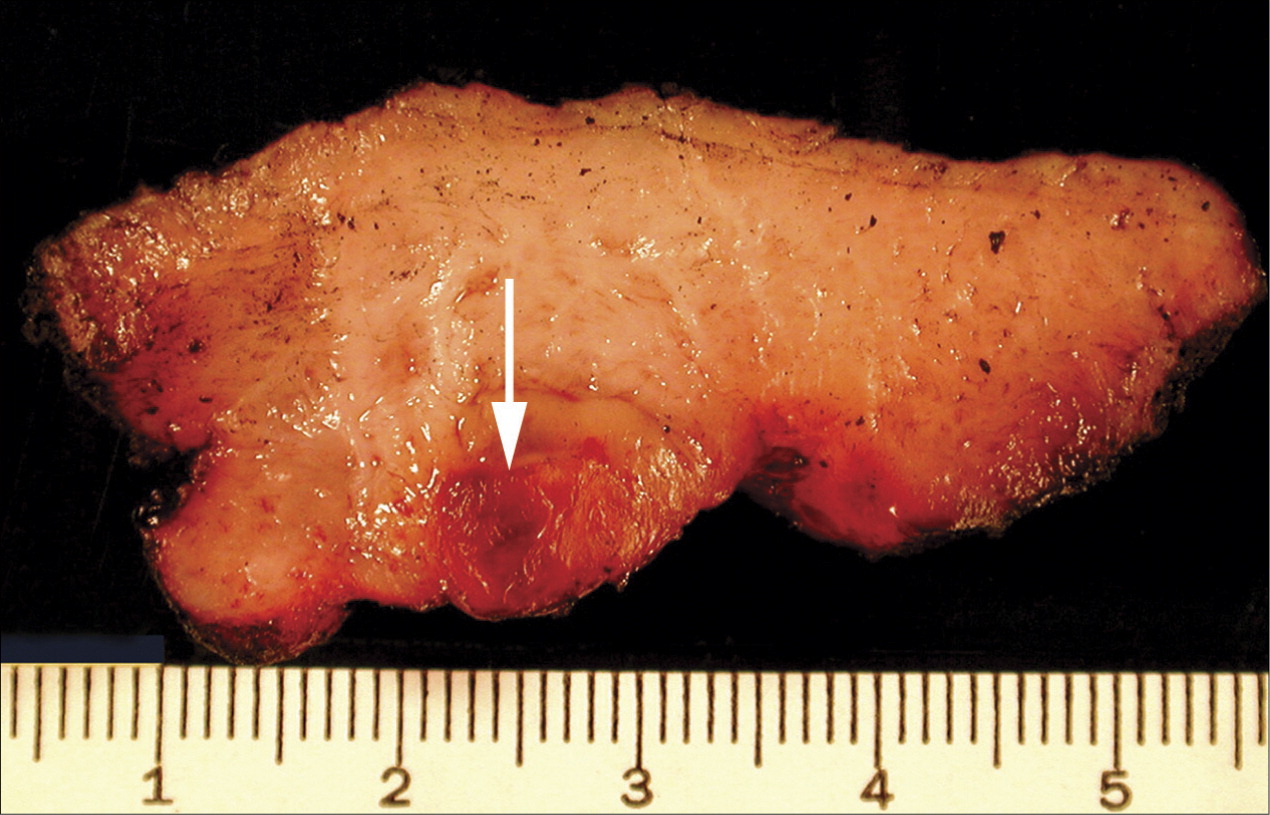 40-facts-about-gestational-trophoblastic-disease