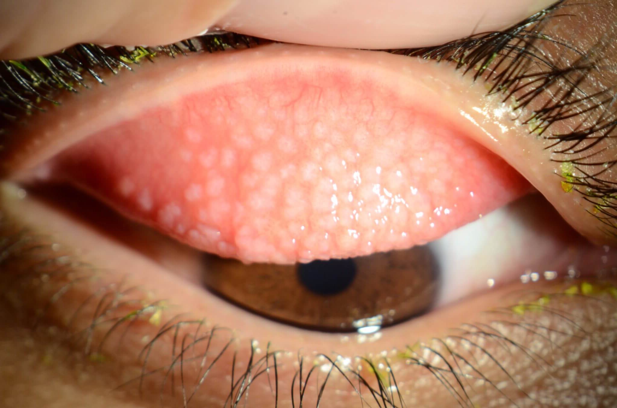 40 Facts About Giant Papillary Conjunctivitis - Facts.net