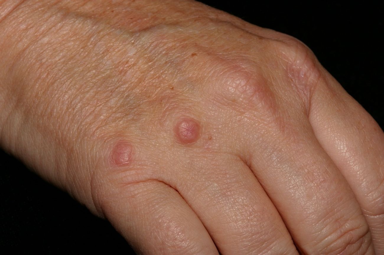 40-facts-about-granuloma-annulare